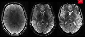 L'IRM Iseult, la plus puissante du monde (11,7 teslas) pour percer les mystères du cerveau